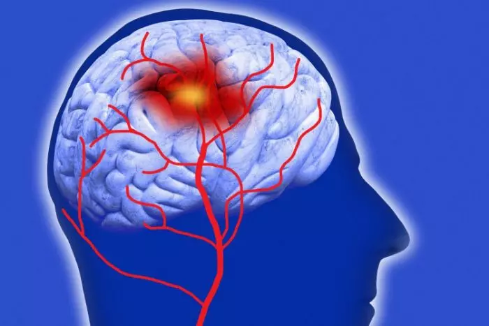 Tai biến mạch máu não: 10 điều cần biết về căn bệnh nguy hiểm này